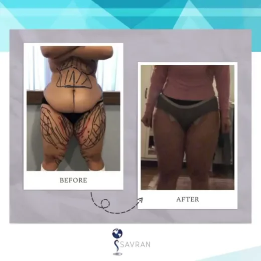 Savran Klinik Estetik Merkezi | Karın Germe - Liposuction - Meme Büyütme